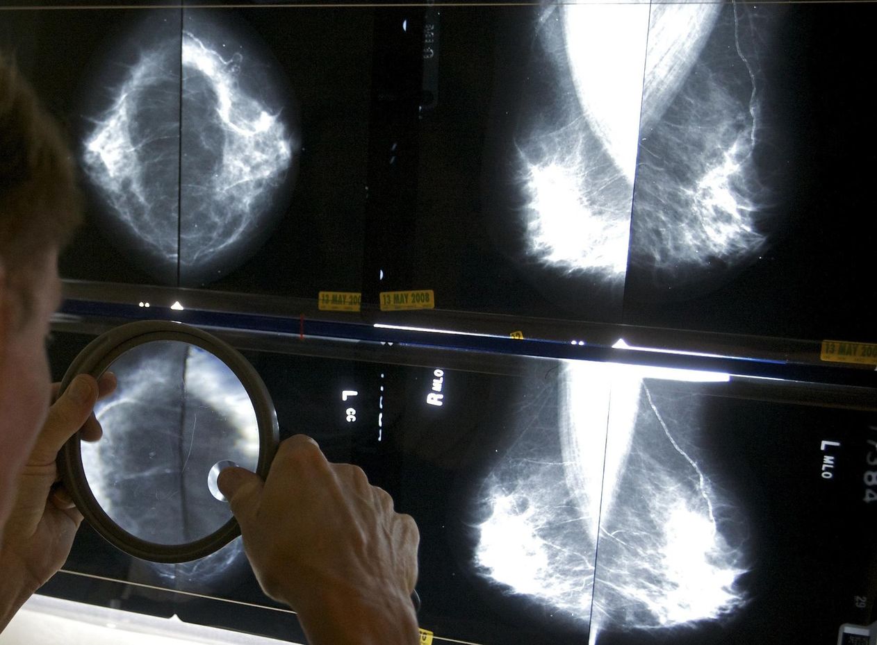 Advanced cancers returned to prepandemic levels, according to a reassuring report