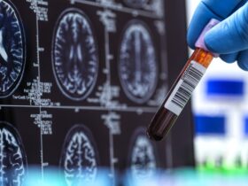 First FDA-cleared Alzheimer’s blood test set to boost diagnoses' speed, accuracy : Shots